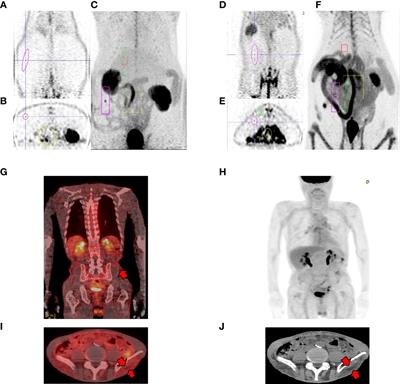 Altered Glucose Metabolism and Glucose Transporters in Systemic Organs After Bariatric Surgery